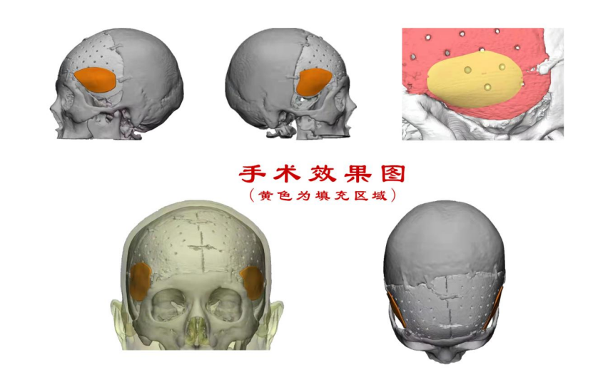 林志颖车祸致颜面骨折，医生：或可用3D打印建模进行术后修复