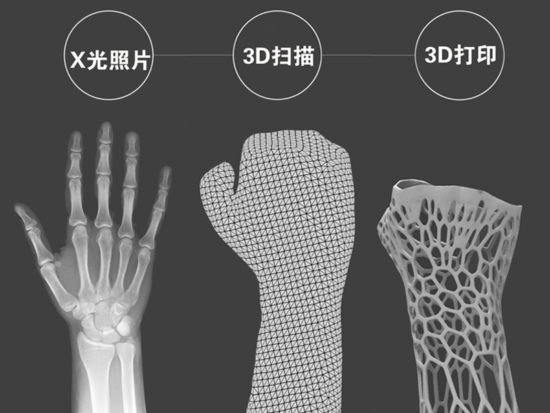 陕西非凡士分享FDM3D打印在医疗行业的应用案例