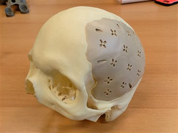 南京3D打印机：3D打印机的医疗骨骼