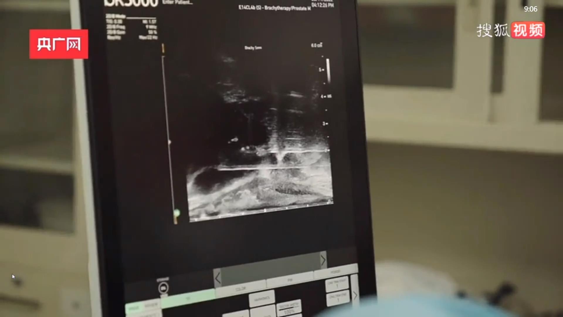3D打印穿刺模板，天津成功完成首例前列腺癌放射治疗