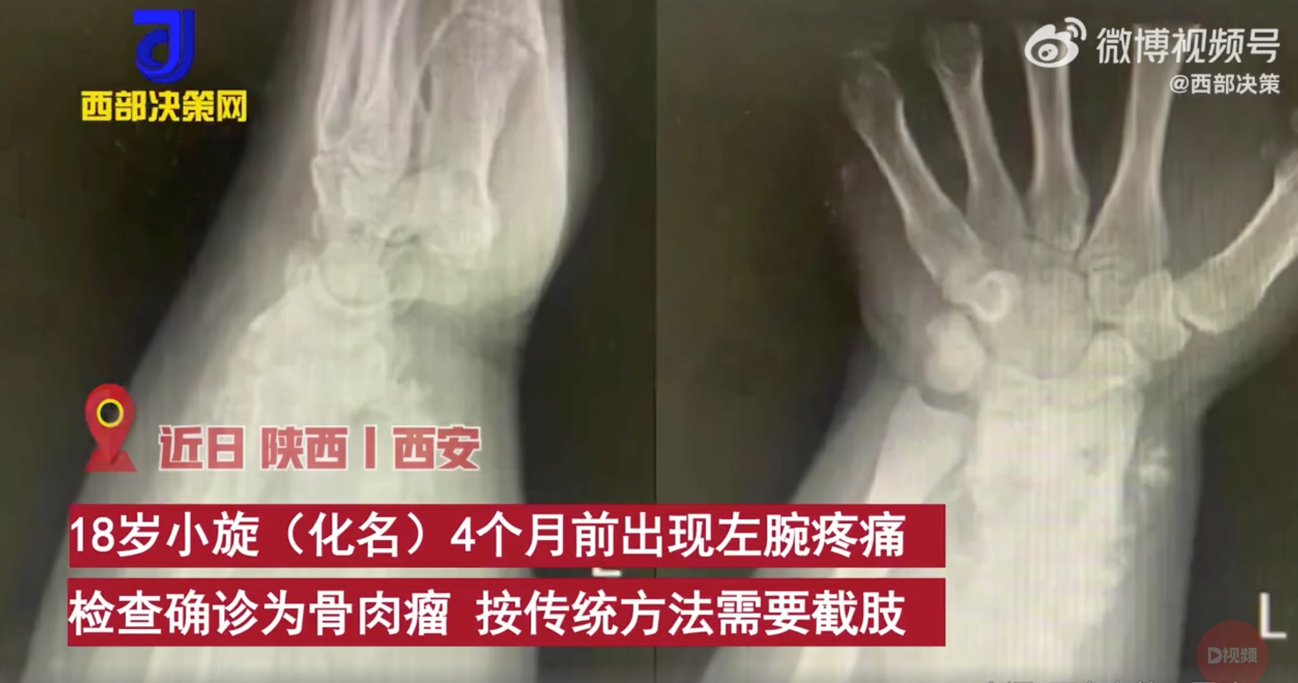 3D打印保住骨肉瘤患者左手,这项“黑科技”还能干点啥