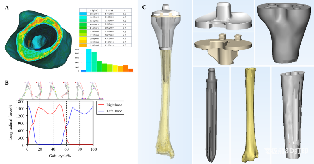 基于拓扑优化技术的3D打印胫骨重建假体治疗胫骨近端严重骨缺损
