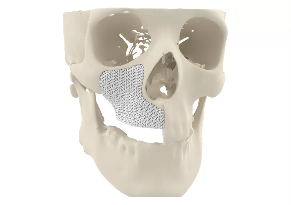 癌症患者利用3D打印机完成鼻部骨骼重建
