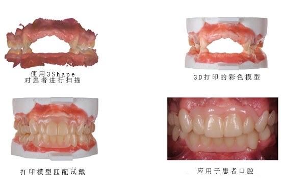 3Shape彩色工作流程，让牙齿假体越来越“真”！