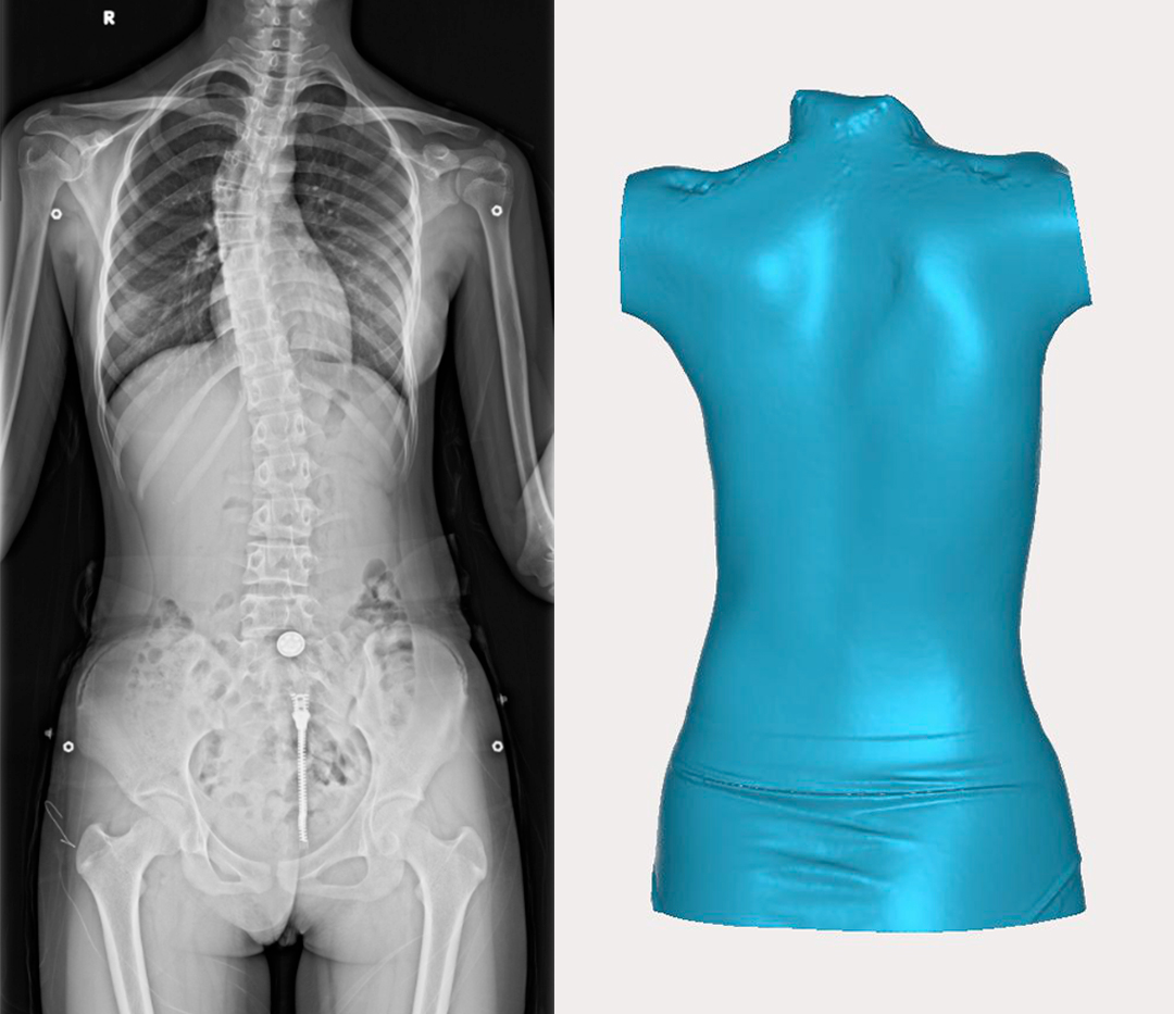 GREENSCANR系列3D扫描仪在脊柱矫正治疗中的应用