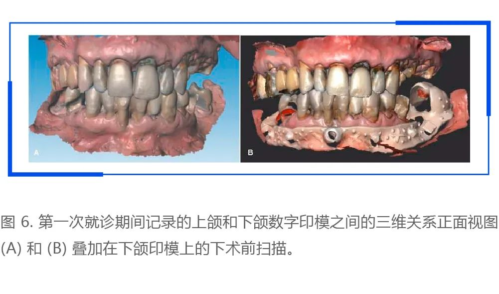 利用口腔扫描仪进行术前口内扫描和数字化设计